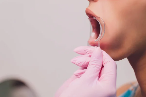 O dentista comparando pacientes sombra de dentes com amostras para o tratamento de branqueamento. — Fotografia de Stock