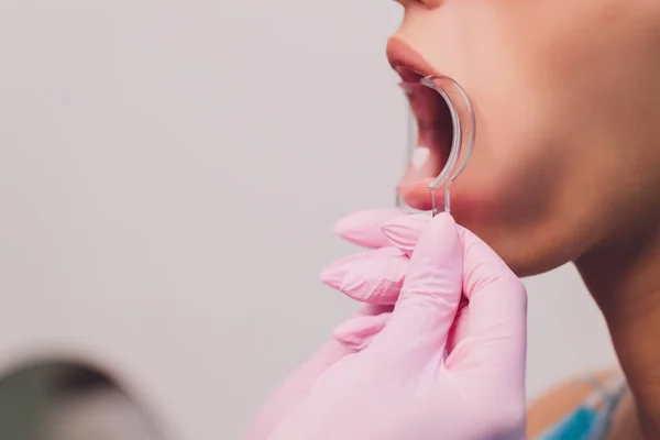 The dentist comparing patients teeth shade with samples for bleaching treatment. — Stock Photo, Image