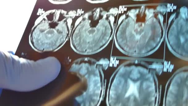 El médico mira a través de la radiografía del cerebro. Instantánea de la resonancia magnética de la cabeza . — Vídeo de stock