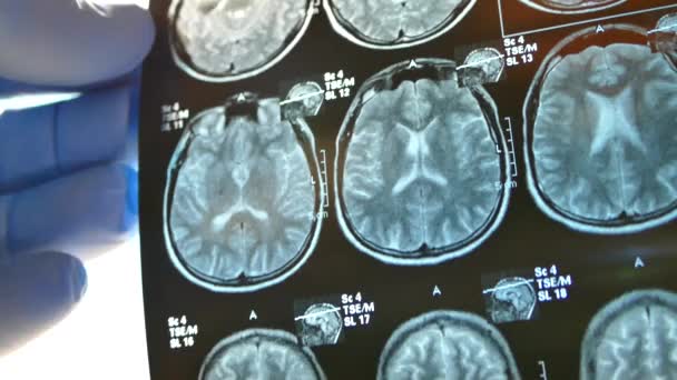 Schaut der Arzt durch das Röntgenbild des Gehirns. Schnappschuss vom mri des Kopfes. — Stockvideo