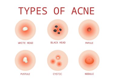 6 Types of Acne, Vector clipart