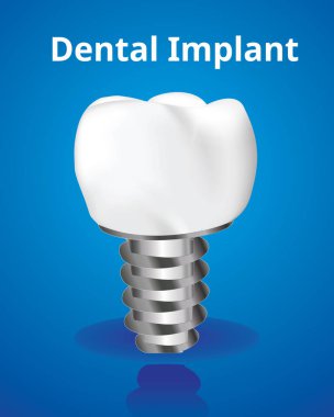 Diş implantı, vida, diş bakımı kavramı, gerçekçi tasarlamak vektör.