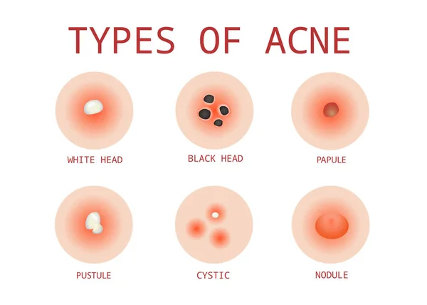 Tipos Acné Vector — Archivo Imágenes Vectoriales