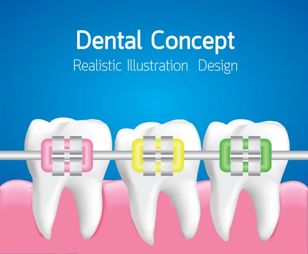 Dentes Com Aparelho Colorido Conceito Cuidados Dentários Ilustração Realista Vector — Vetor de Stock