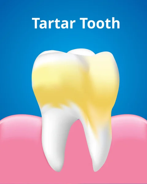 Dent Tartre Avec Gomme Concept Soins Dentaires Illustration Réaliste Vectorielle — Image vectorielle