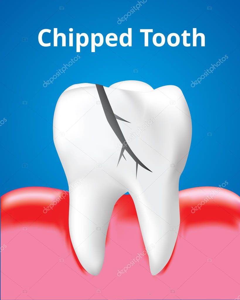 Chipped tooth with Inflamed gum, Dental care concept, Realistic design illustration Vector.