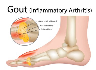 Gut (inflamatuar artrit) gut artrit, illüstrasyon - vektör yoğun acı bir türüdür
