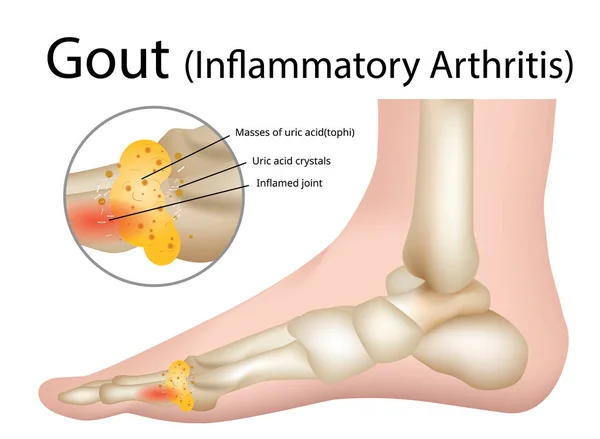 Gikt Inflammatorisk Artrit Gikt Intensivt Smärtsamma Artrit Illustration Vektor — Stock vektor