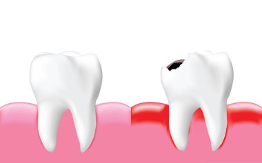 Decay tooth with inflammation and healthy tooth, isolated on white background, Realistic illustration Vector. clipart