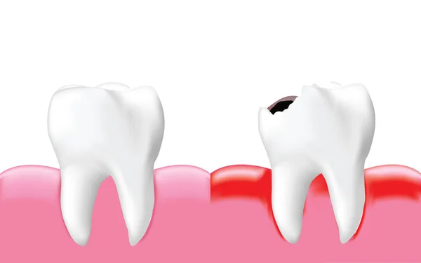 炎症と健康な歯 白い背景に 現実的なイラスト ベクトルに分離された崩壊歯 — ストックベクタ