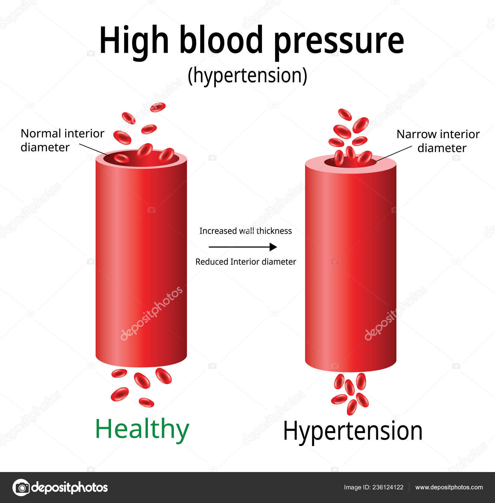 Hypertension Vecteur D'hypertension Artérielle Deux Vaisseaux Sanguins Usage Scientifique