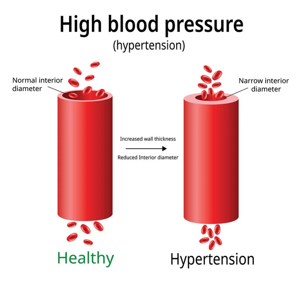 Hipertensión Vector Presión Arterial Alta Dos Vasos Sanguíneos Ciencia Uso — Archivo Imágenes Vectoriales