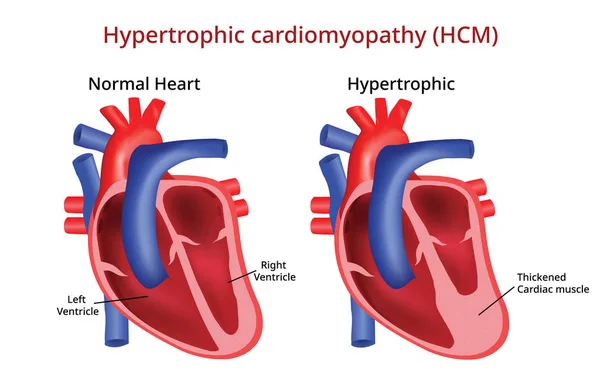 Hypertrophic Cardiomyopathy Heart Disease — Stock Vector