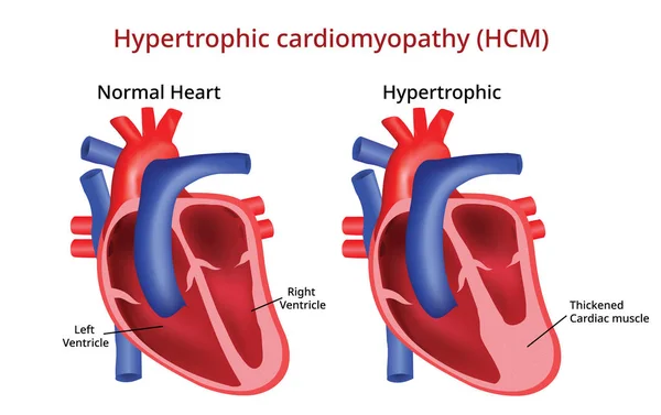 Hipertrofik kardiyomiyopati, kalp hastalığı