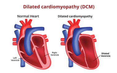 Dilate kardiyomiyopati, kalp hastalığı, vektör görüntü