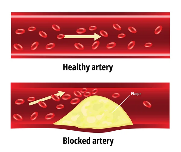 Arteria bloccata, grasso bloccato nell'arteria sanguigna, colesterolo — Vettoriale Stock