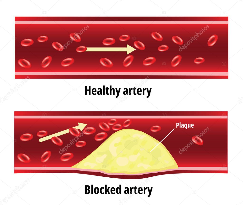 Blocked artery, fat stuck in the blood artery, cholesterol