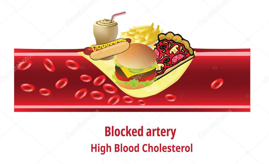 high blood cholesterol, Junk Food