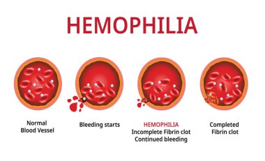 Hemophilia. damaged blood vessel, Haemophilia (Coagulation disorder) - Vector clipart