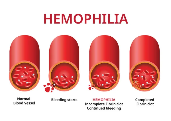 Гемофилия. поврежденный кровеносный сосуд, гемофилия (нарушение свертываемости) - вектор — стоковый вектор
