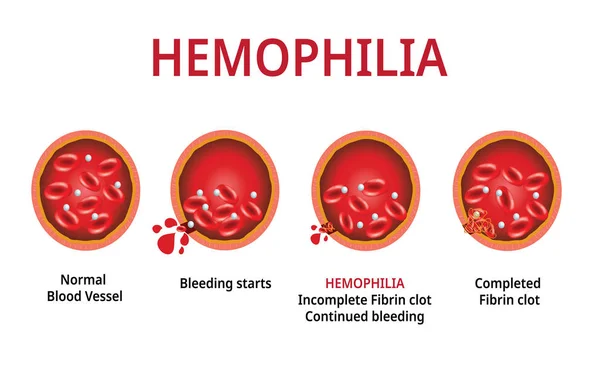 Hemofilia. vaso sanguíneo dañado, hemofilia (trastorno de coagulación) - Vector — Vector de stock