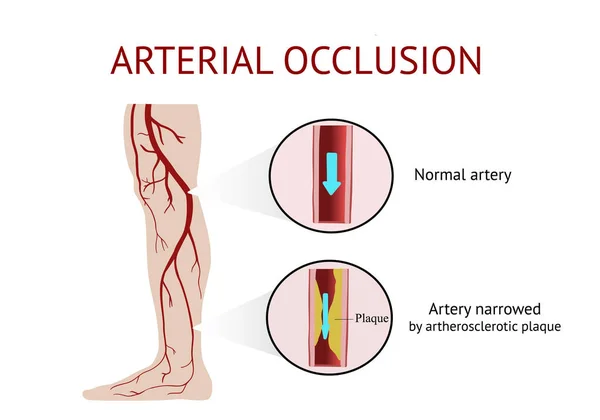 Occlusione Arteriosa Occlusione Arteriosa Acuta Aterosclerosi Crampo Illustrazione Vettoriale — Vettoriale Stock