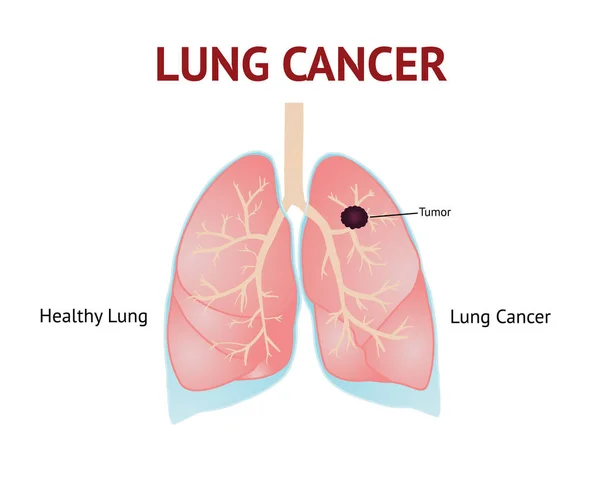 Lungs cancer, lungs disease, isolated vector illustration on White background.