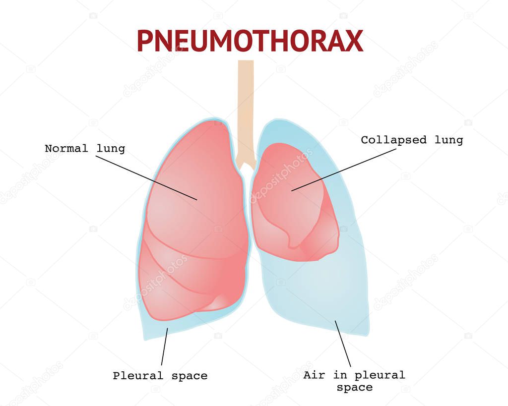 Collapsed lung or Pneumothorax, lungs disease, isolated vector illustration on White background.