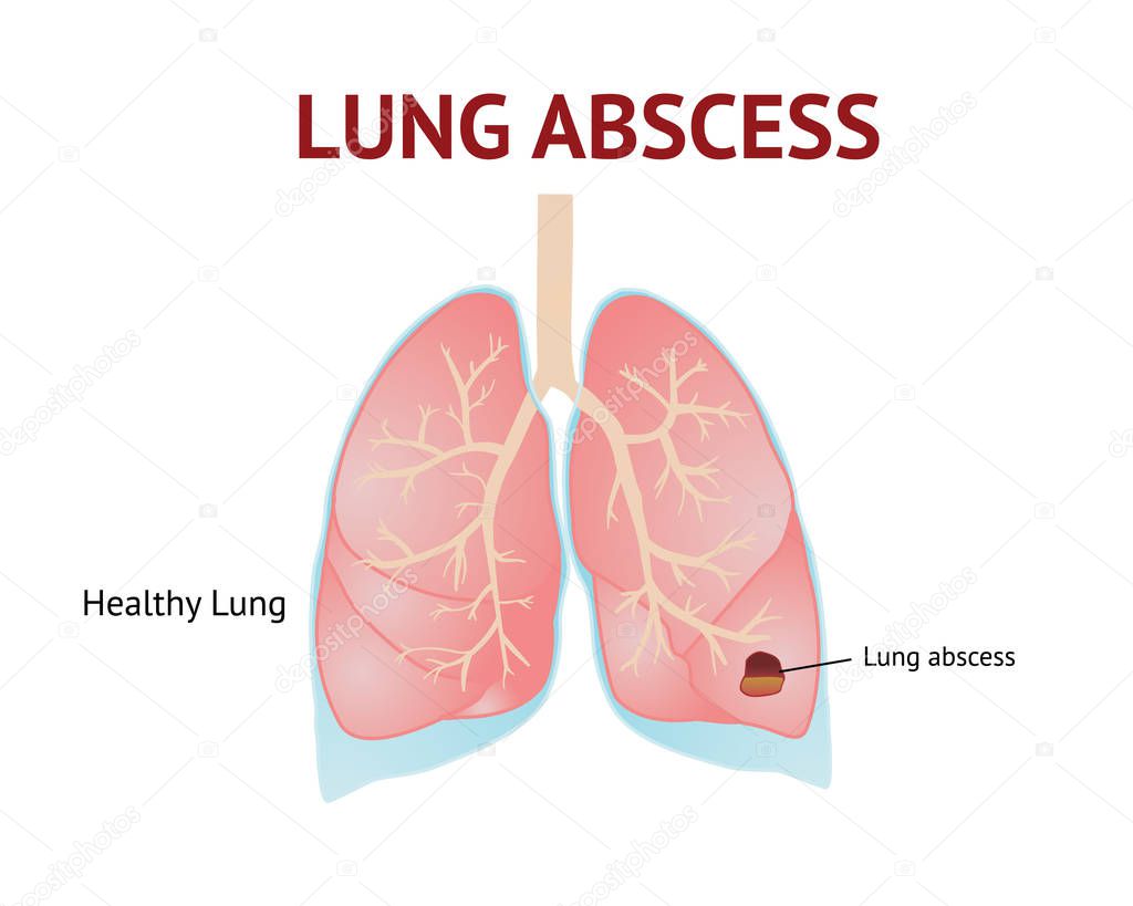 Lungs abscess, lungs disease, isolated vector illustration on White background.