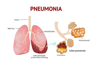 Pnömoni, Lobar pnömonisi, Beyaz arka planda izole vektör çizimi.