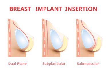 Meme implantı ekleme, Meme cerrahisi silikon, 3d Gerçekçi tasarım Vektör.
