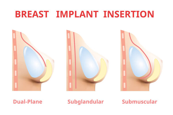 Breast implant insertion, Breast surgery silicone, 3D Realistic design Vector.