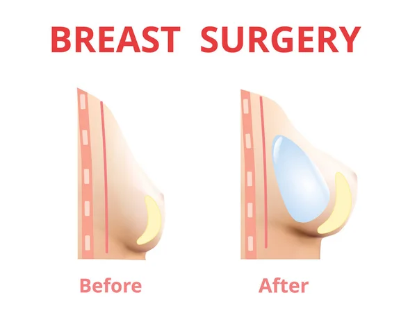 Implante mamário antes e depois, Cirurgia plástica, 3D Design realista Vector . —  Vetores de Stock