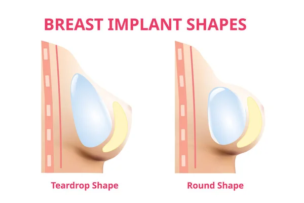 乳房インプラント丸型と涙液形状、乳房手術、3Dリアルなデザインベクトル. — ストックベクタ