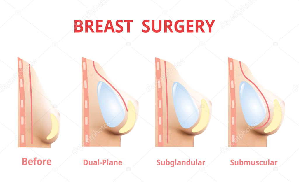 Breast implant before and after, Plastic surgery, 3D Realistic design Vector.