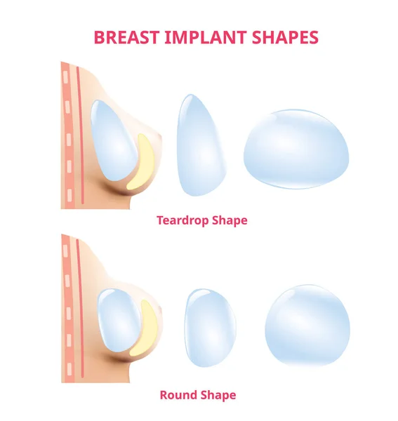 Silicone Breast Implants, compare round and tear drop, Realistic design vector. — Stock Vector