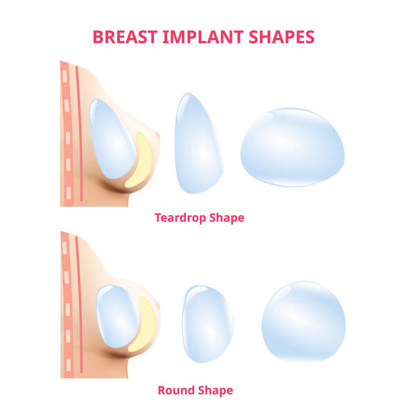 Silicone Breast Implants, compare round and tear drop, Realistic design vector.