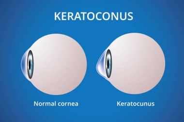 Eye cornea and keratoconus, eye disorder, medical vector clipart