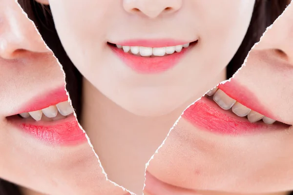 Close Mulher Com Dentes Branquear Conceito — Fotografia de Stock