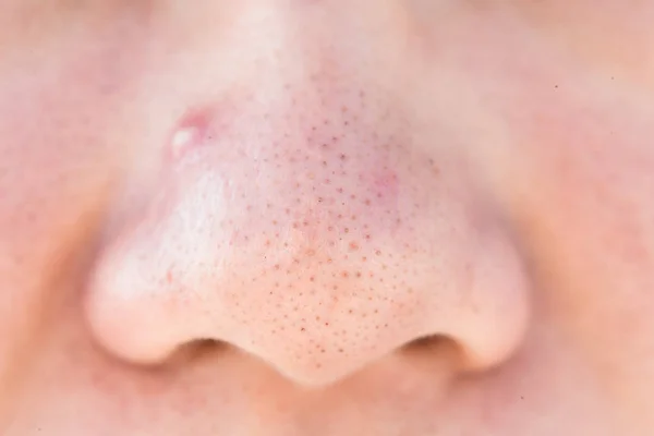 鼻子上的粉刺是健康概念的特写 — 图库照片