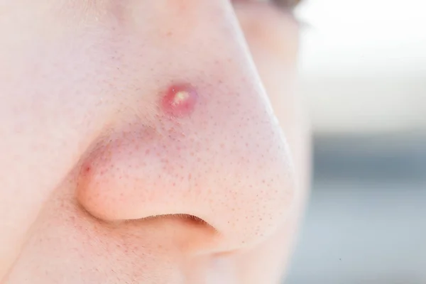 Primer Plano Del Acné Facial Para Cocept Salud — Foto de Stock