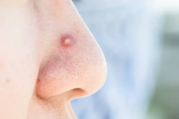 Close Facial Acne Health Cocept — Stock Photo, Image