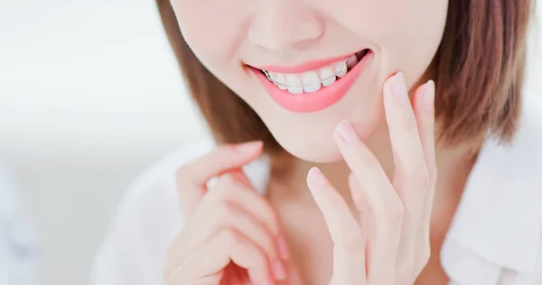 Close Beauty Woman Wear Retainer Teeth Happily — Stock Photo, Image