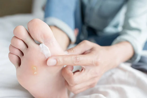 Aplicación de crema para los atletas pie — Foto de Stock