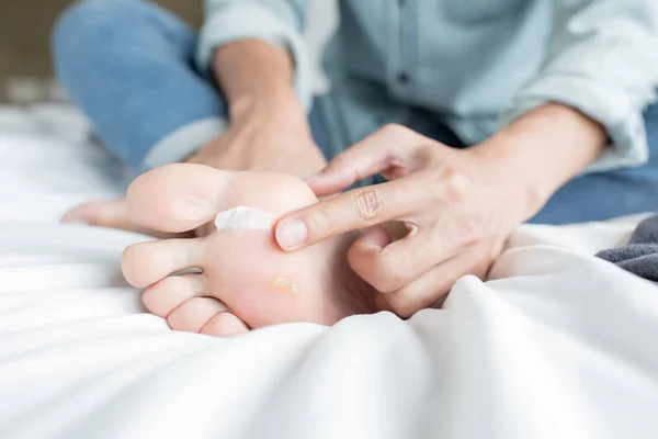 Applying cream for athletes foot — Stock Photo, Image