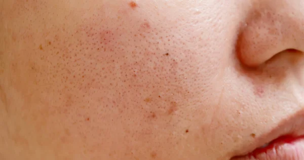 Acne no rosto da mulher — Fotografia de Stock