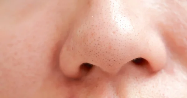 Blackheads on woman nose — Stock Photo, Image