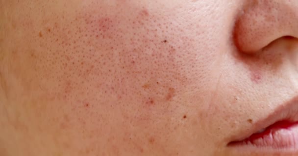 Acne sul viso della donna — Video Stock