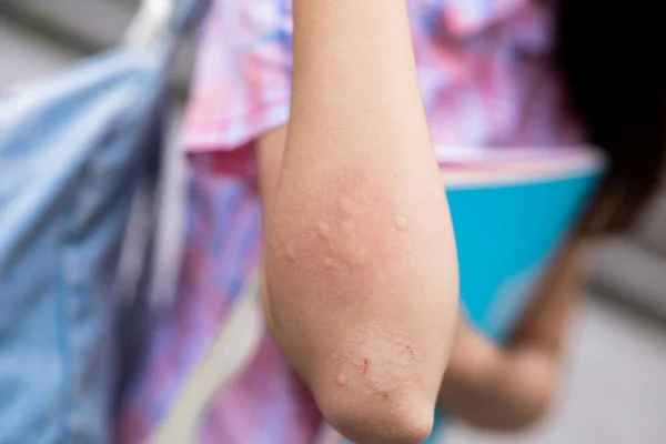 Brazo Una Chica Picado Por Mosquito Recibe Golpes Piel Verano — Foto de Stock