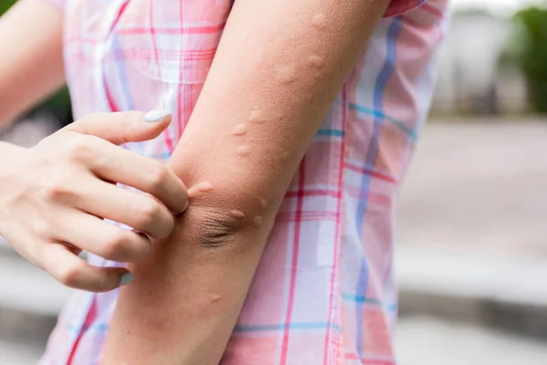 Brazo Gilr Picado Por Mosquito Recibe Protuberancias Piel Verano — Foto de Stock